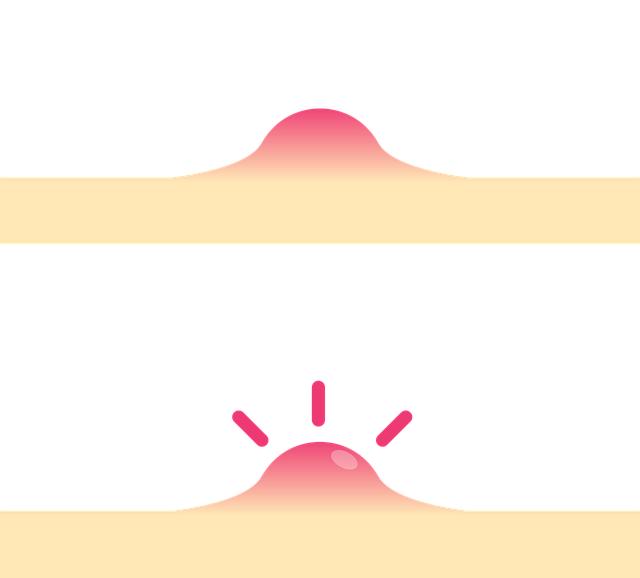 - Krok za krokem: Jak zabránit zhoršení pleťových problémů při akné po kotvičníku